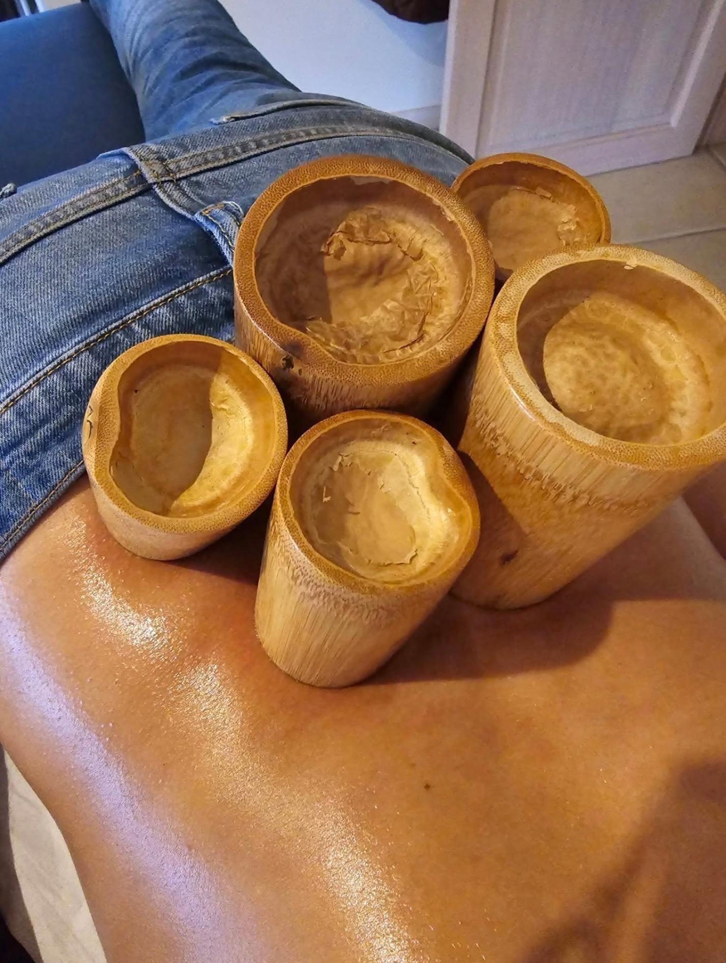Close-up van traditionele Hijama cupping kopjes op rug behandeling met therapeutische markeringen